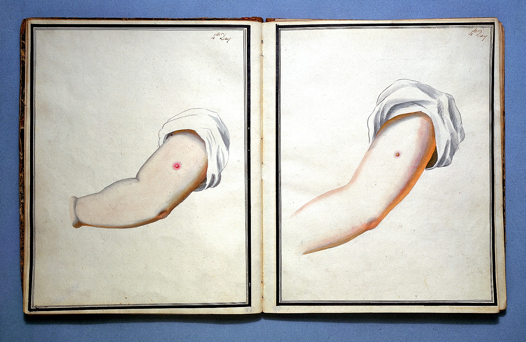 L0015944 Drawings showing smallpox and cowpox inoculation.