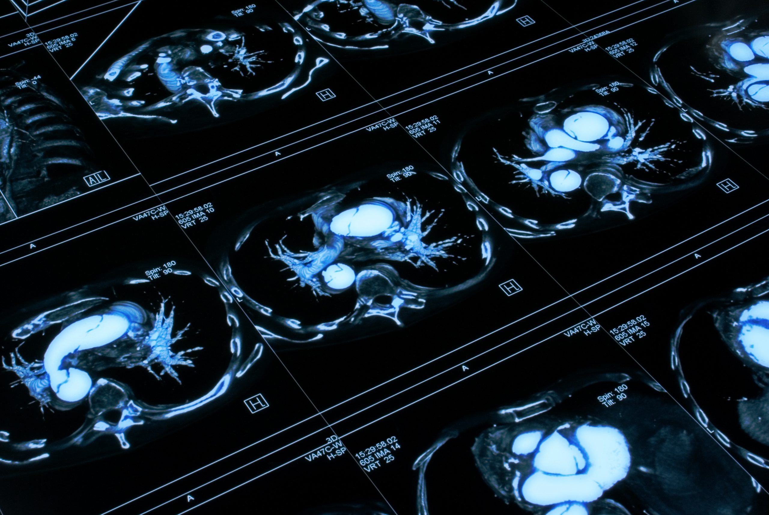 Chest tomogram