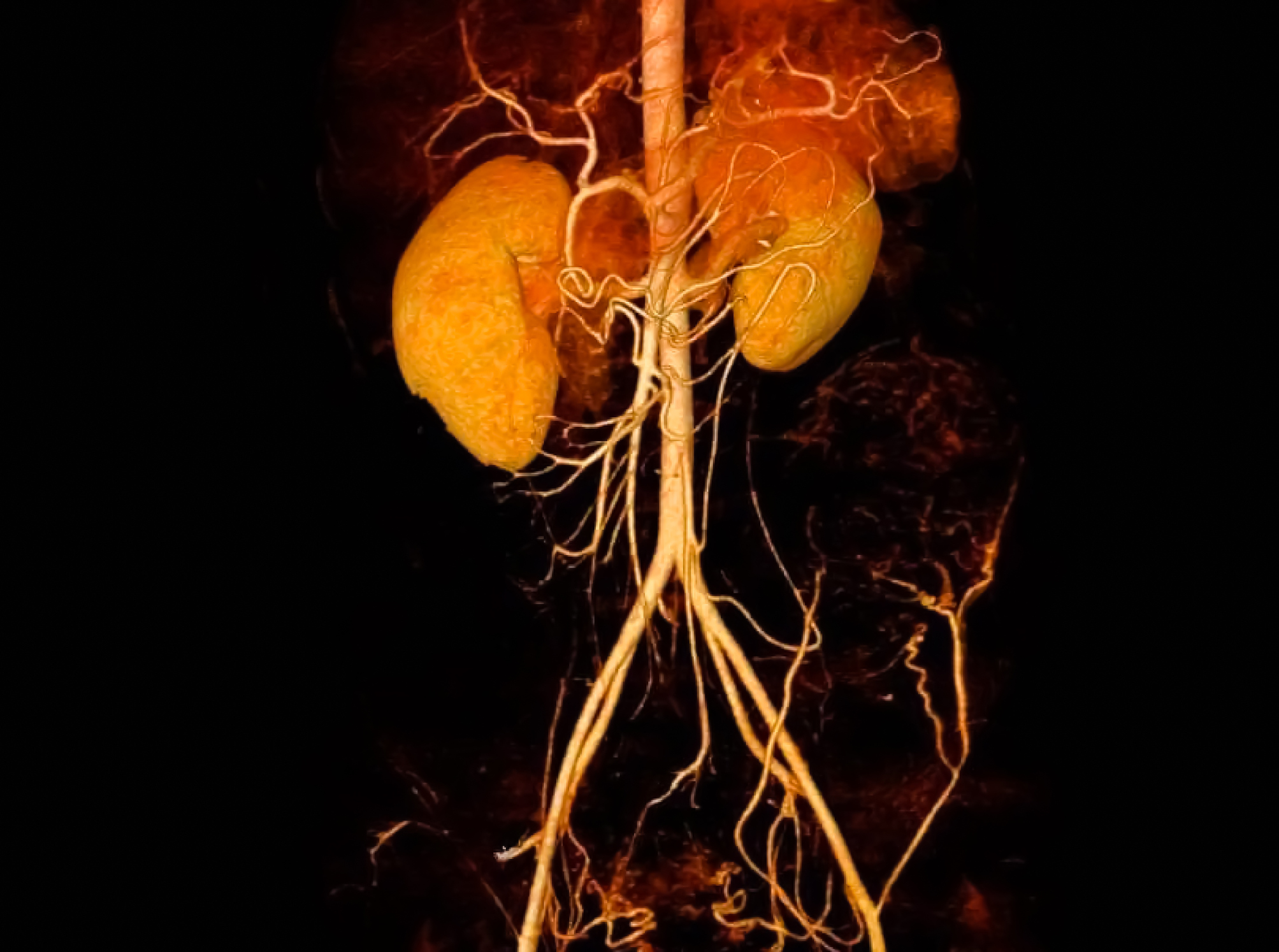 Photo of CT angiogram shown the aorta , kidney and common iliac artery with 3D reconstruction on dark background. Focus on the kidney